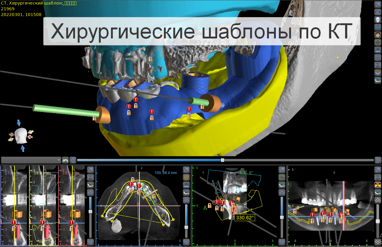 Хирургические шаблоны по КТ пациента