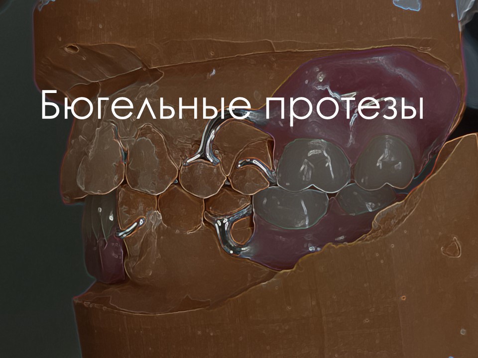 Бюгельное протезирование